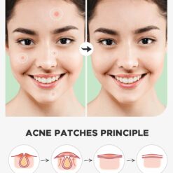 72 Invisible Pimple Patches