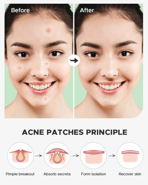 72 Invisible Pimple Patches